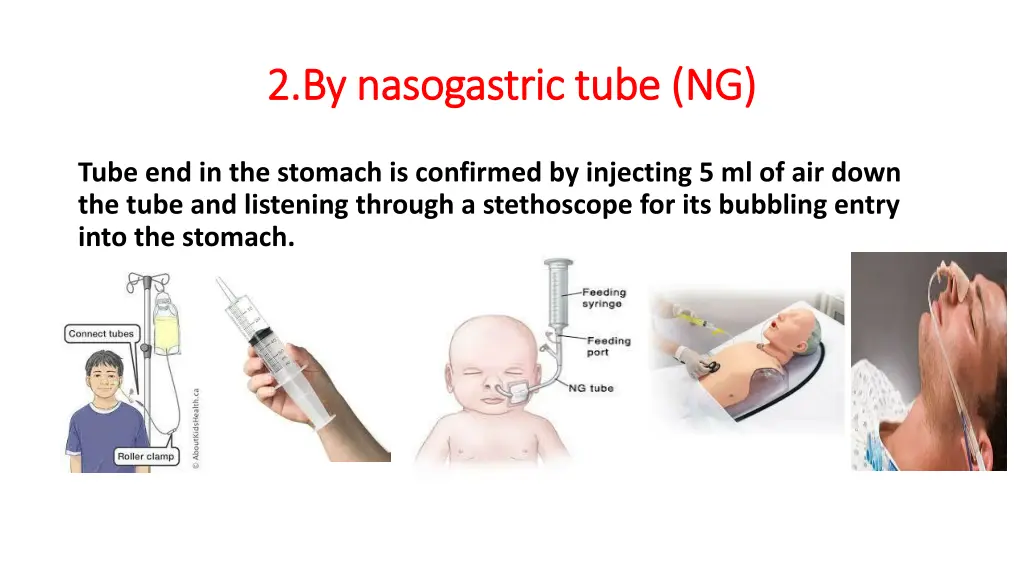 2 by nasogastric tube ng 2 by nasogastric tube ng