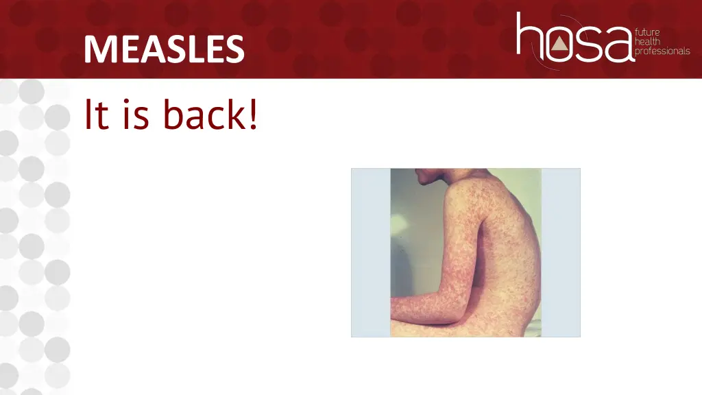 measles it is back
