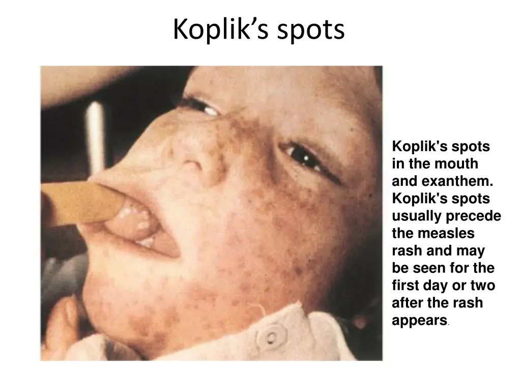 koplik s spots