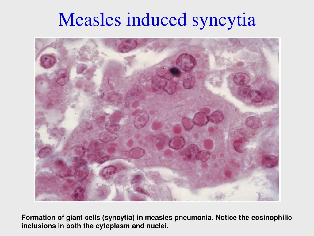 measles induced syncytia