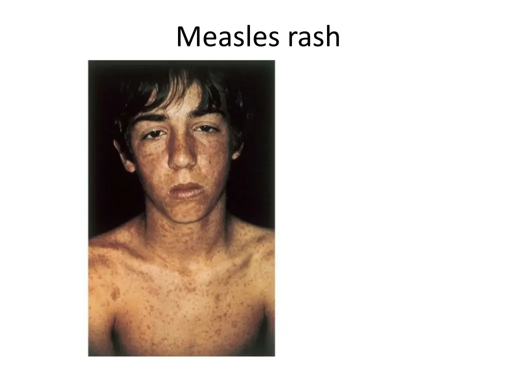 measles rash