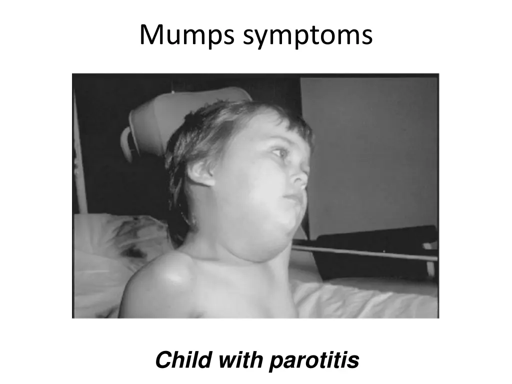 mumps symptoms