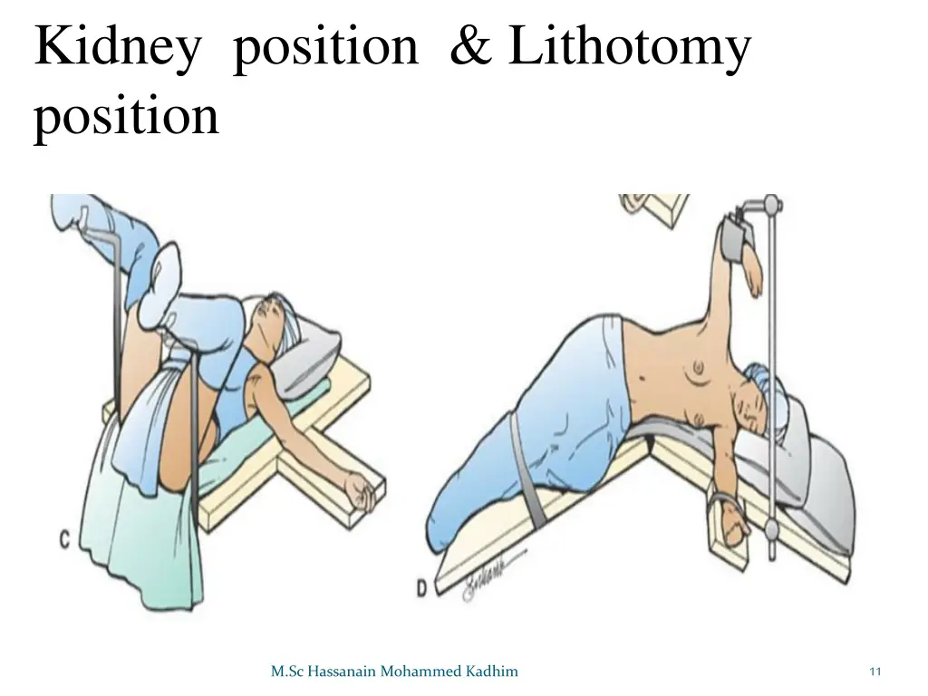 kidney position lithotomy position
