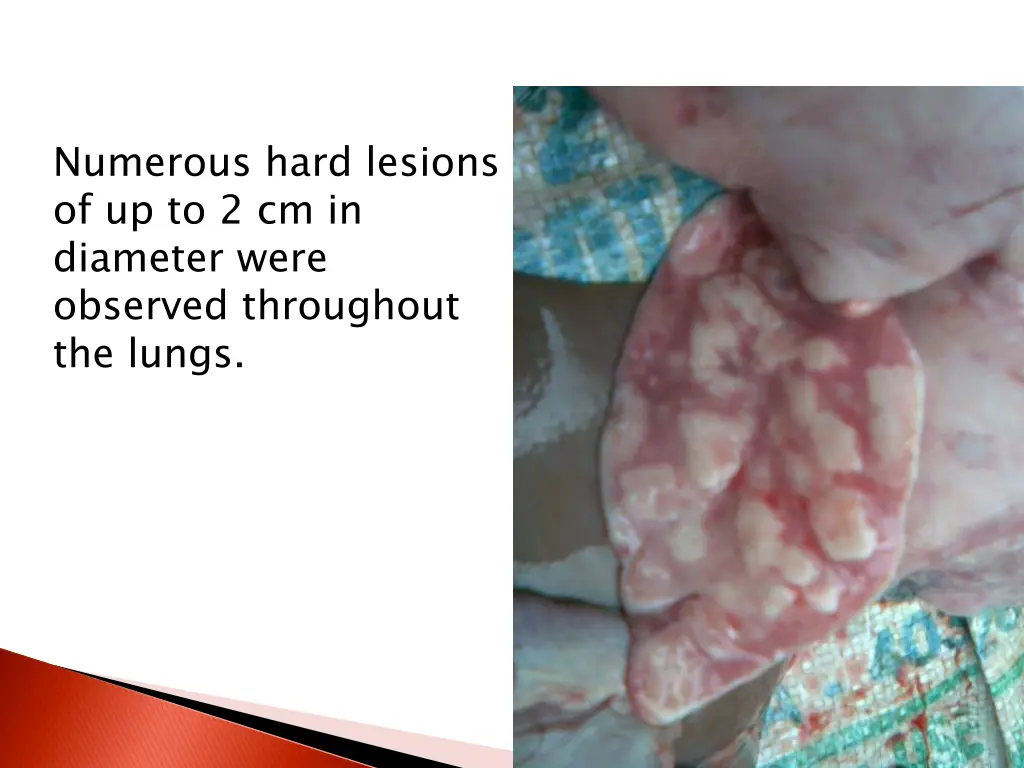 numerous hard lesions of up to 2 cm in diameter