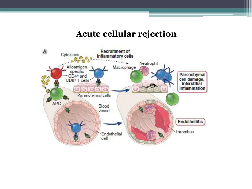 acute cellular rejection