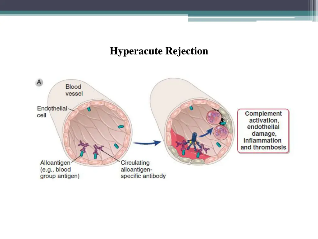 hyperacute rejection 1