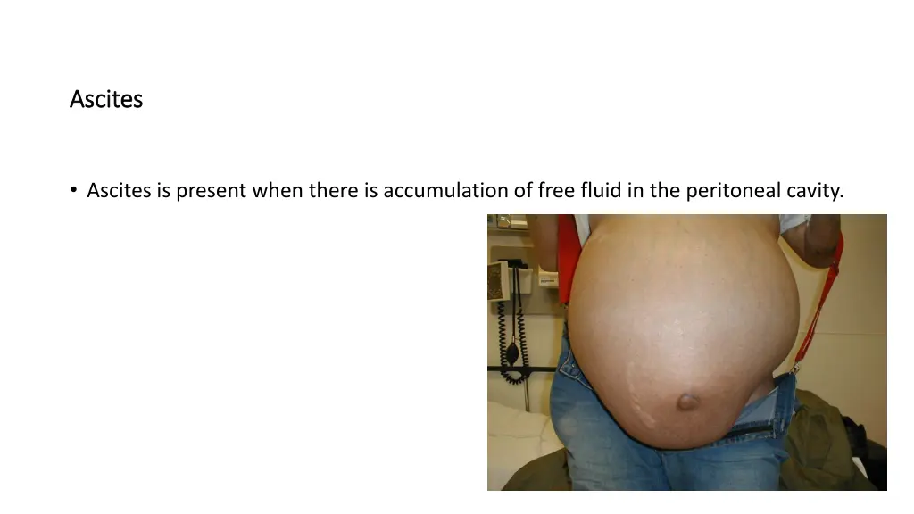 ascites ascites