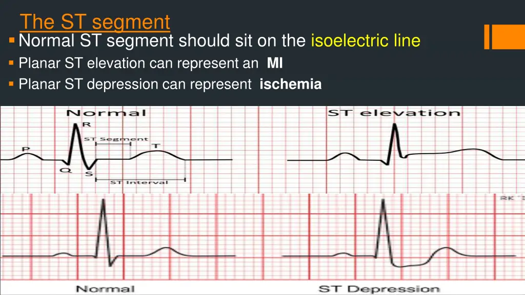 the st segment normal st segment should