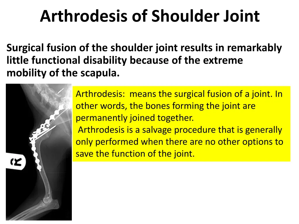 arthrodesis of shoulder joint