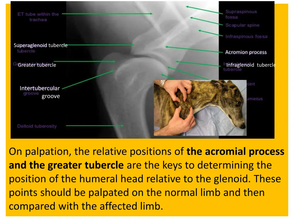 superaglenoid tubercle