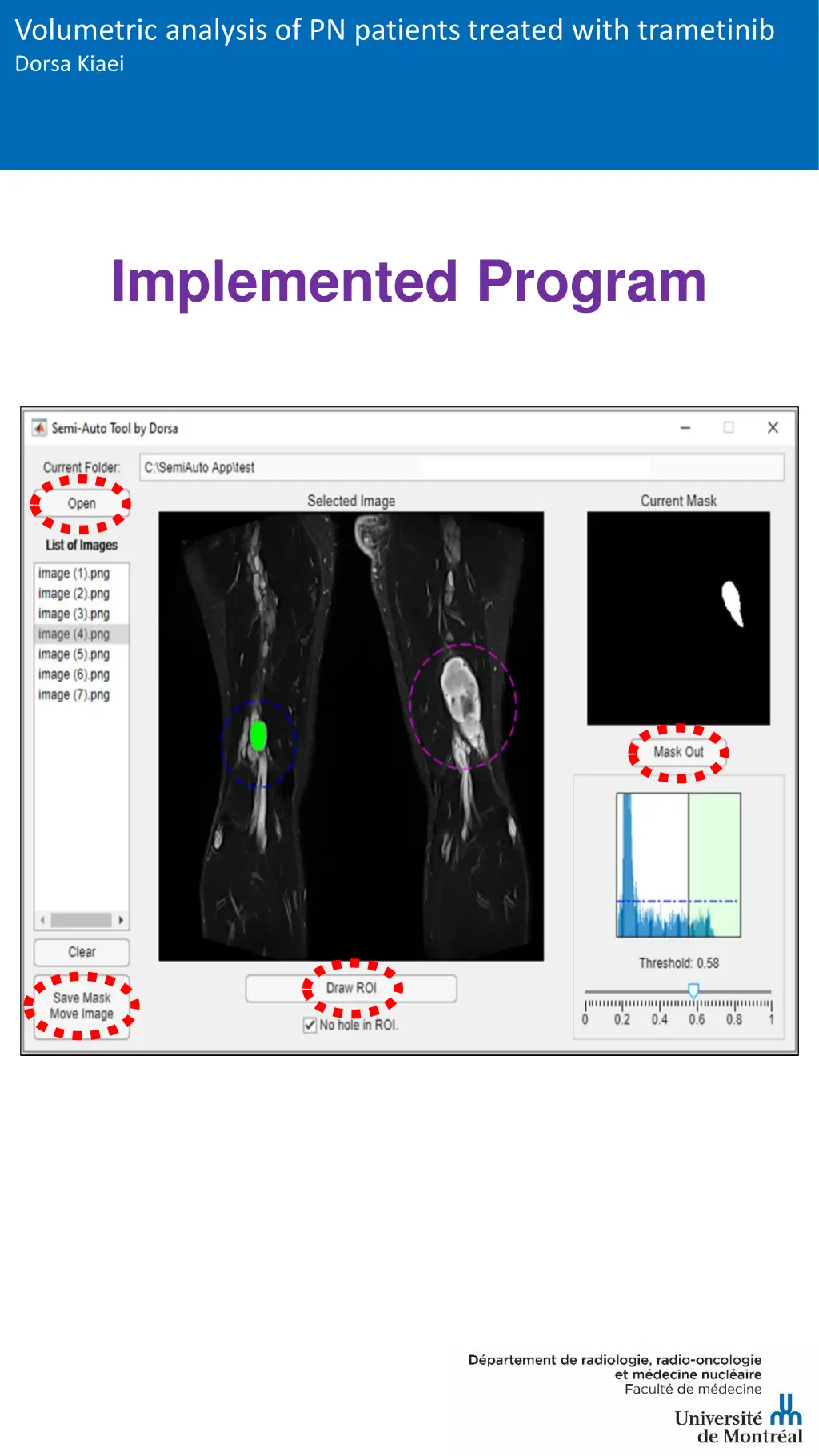 volumetric analysis of pn patients treated with 5