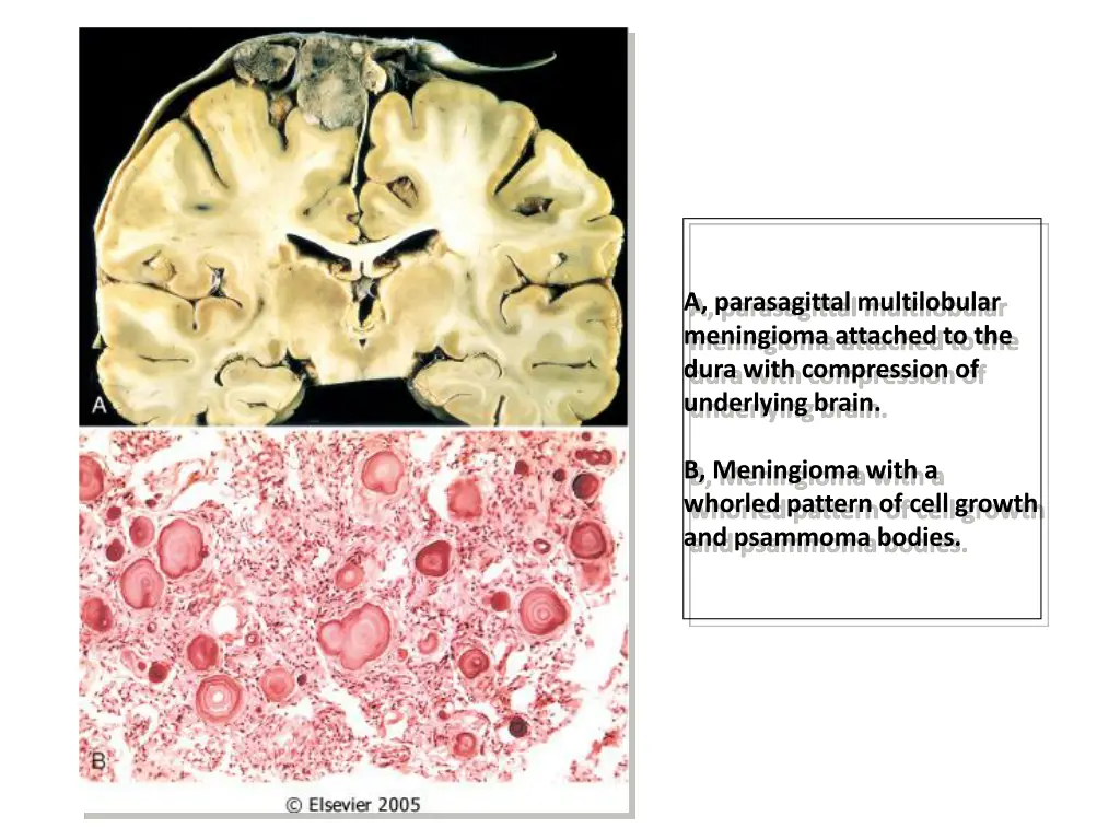 a parasagittal multilobular meningioma attached