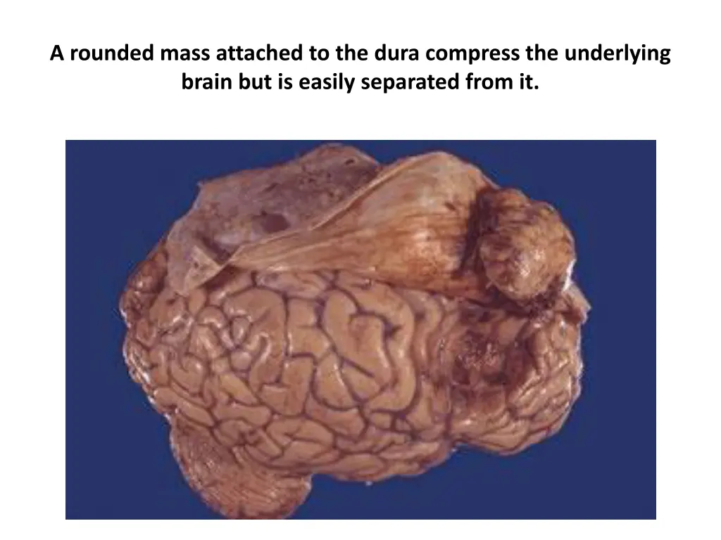 a rounded mass attached to the dura compress