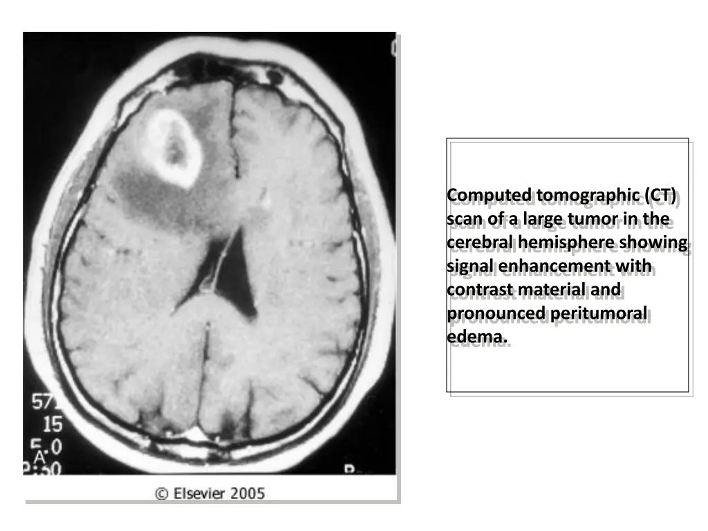 computed tomographic ct scan of a large tumor