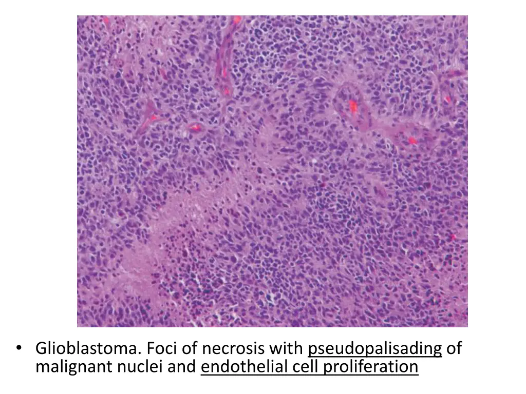 glioblastoma foci of necrosis with 1