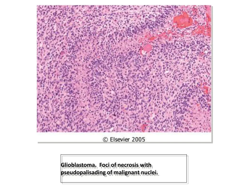 glioblastoma foci of necrosis with