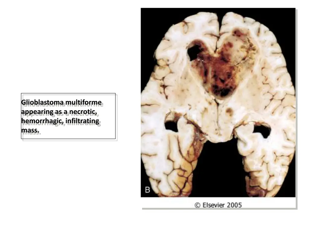 glioblastoma multiforme appearing as a necrotic