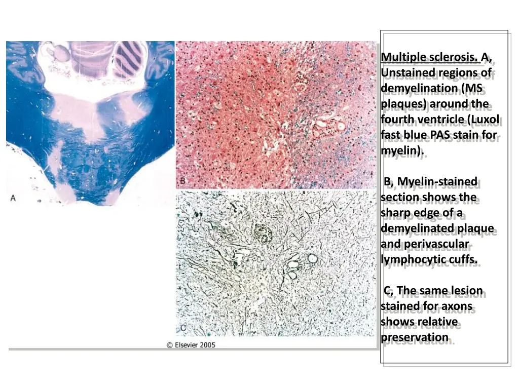 multiple sclerosis a unstained regions