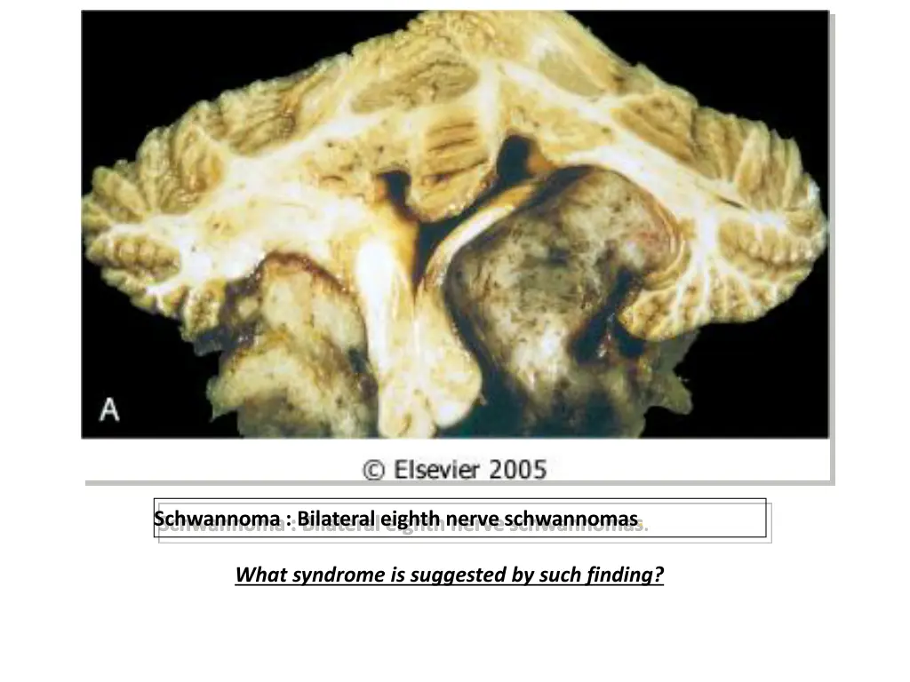 schwannoma bilateral eighth nerve schwannomas