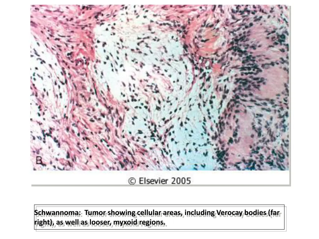 schwannoma tumor showing cellular areas including