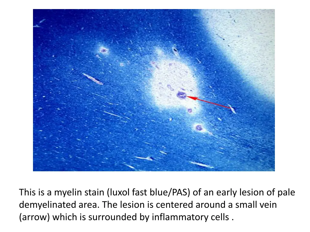 this is a myelin stain luxol fast blue