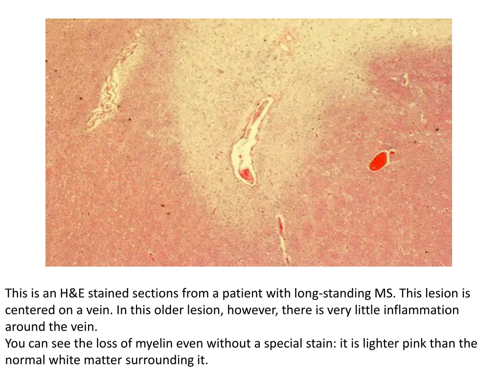 this is an h e stained sections from a patient