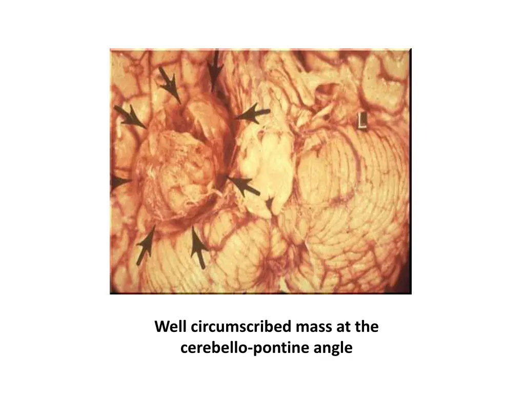 well circumscribed mass at the cerebello pontine
