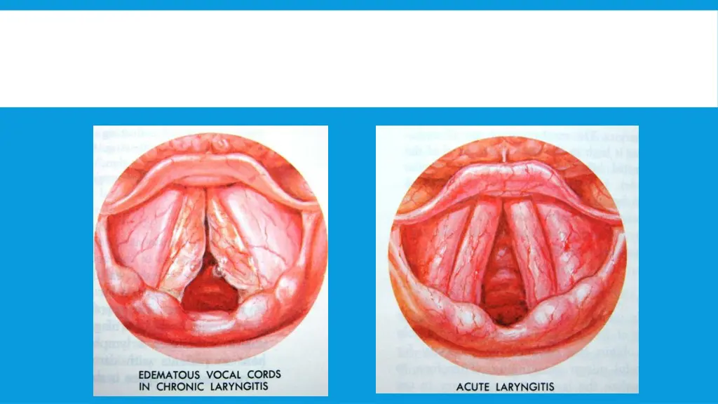 acute laryngitis 1