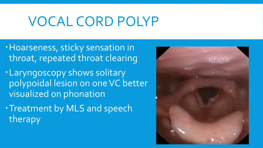 vocal cord polyp 1