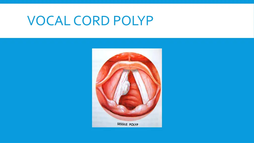vocal cord polyp 2