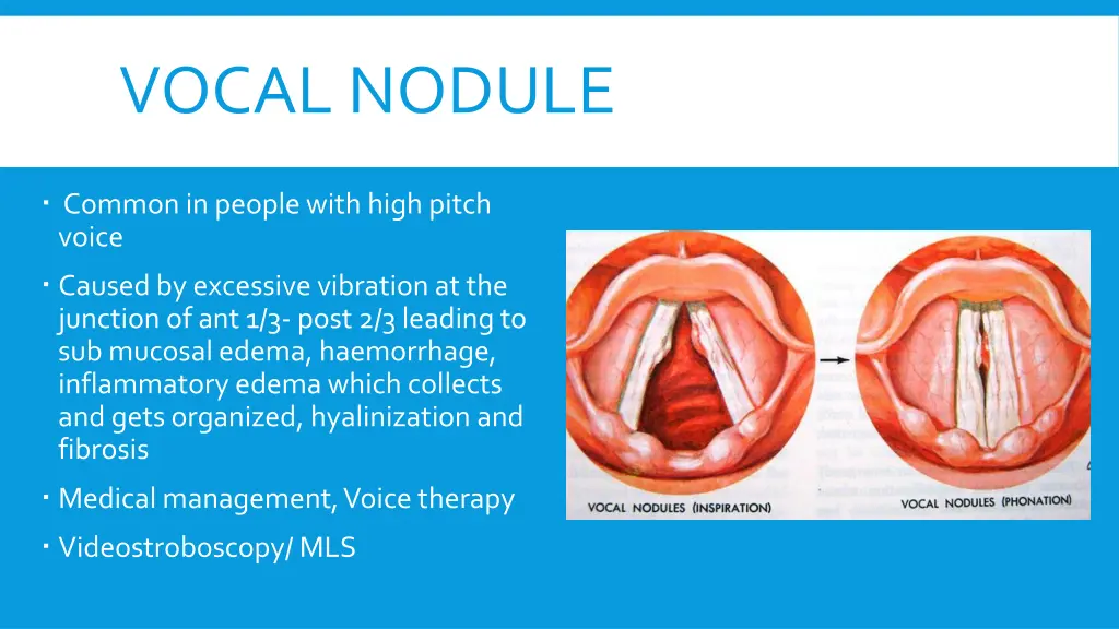 vocal nodule