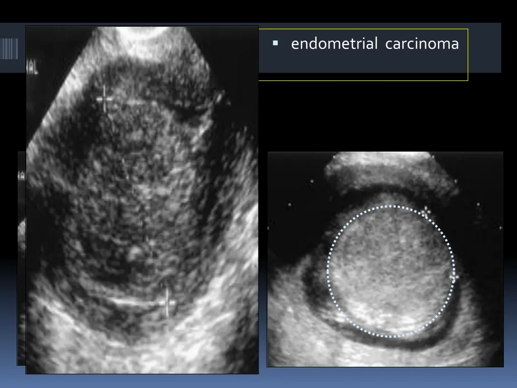 endometrial carcinoma