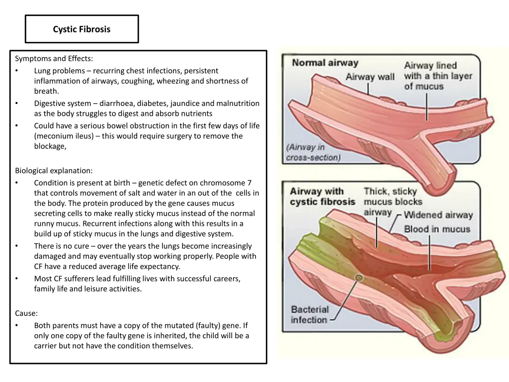cystic fibrosis