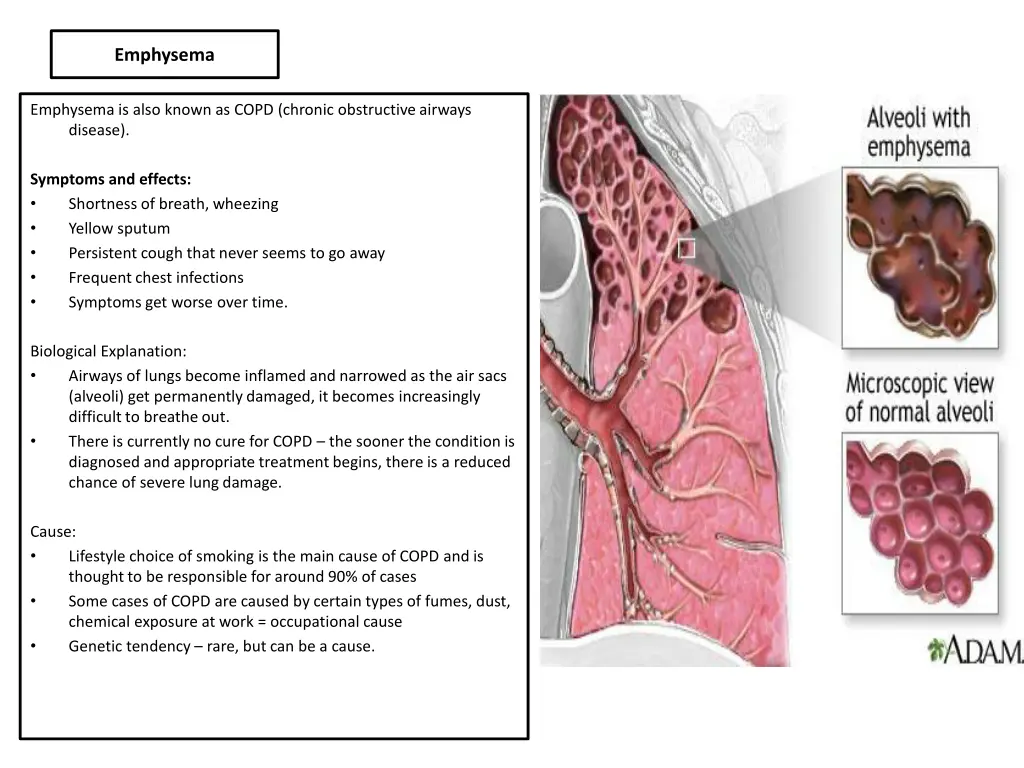 emphysema