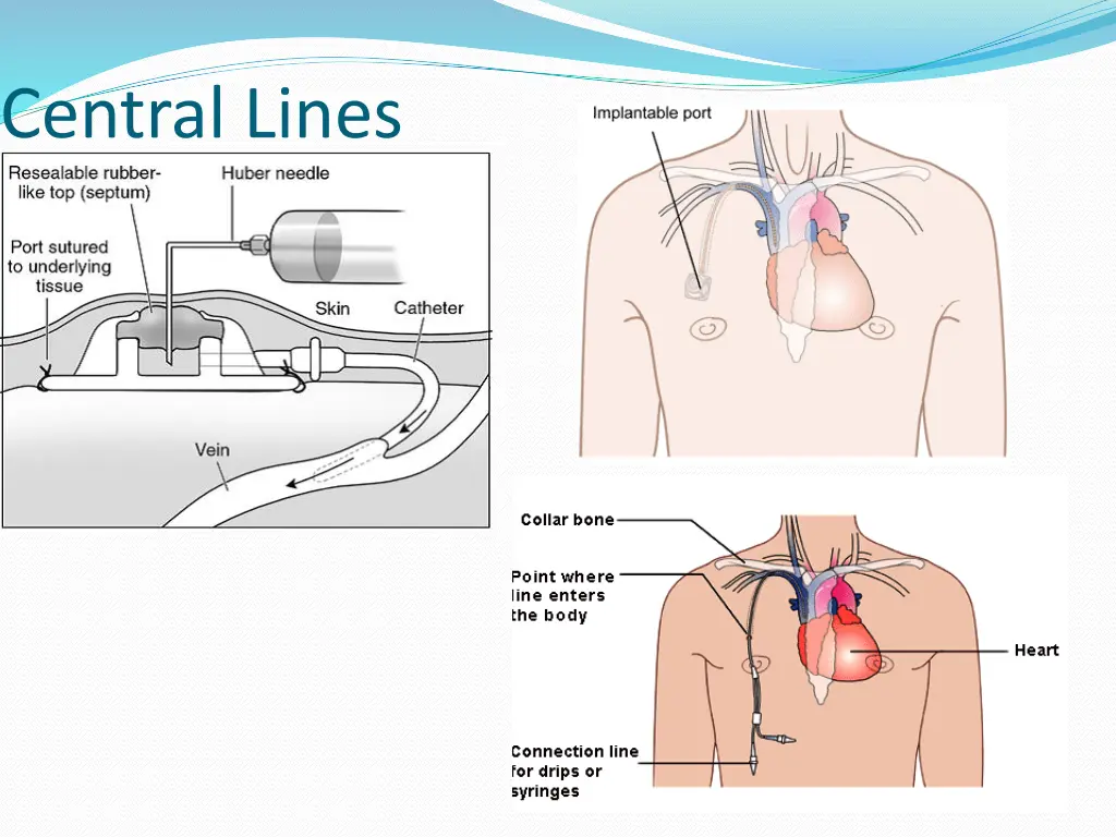 central lines