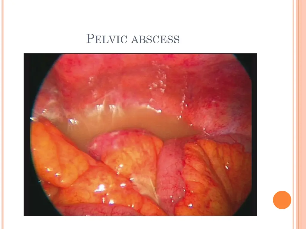 p elvic abscess 1