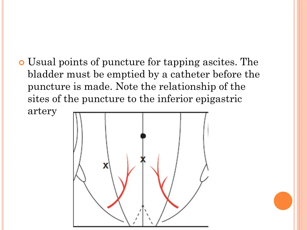 usual points of puncture for tapping ascites