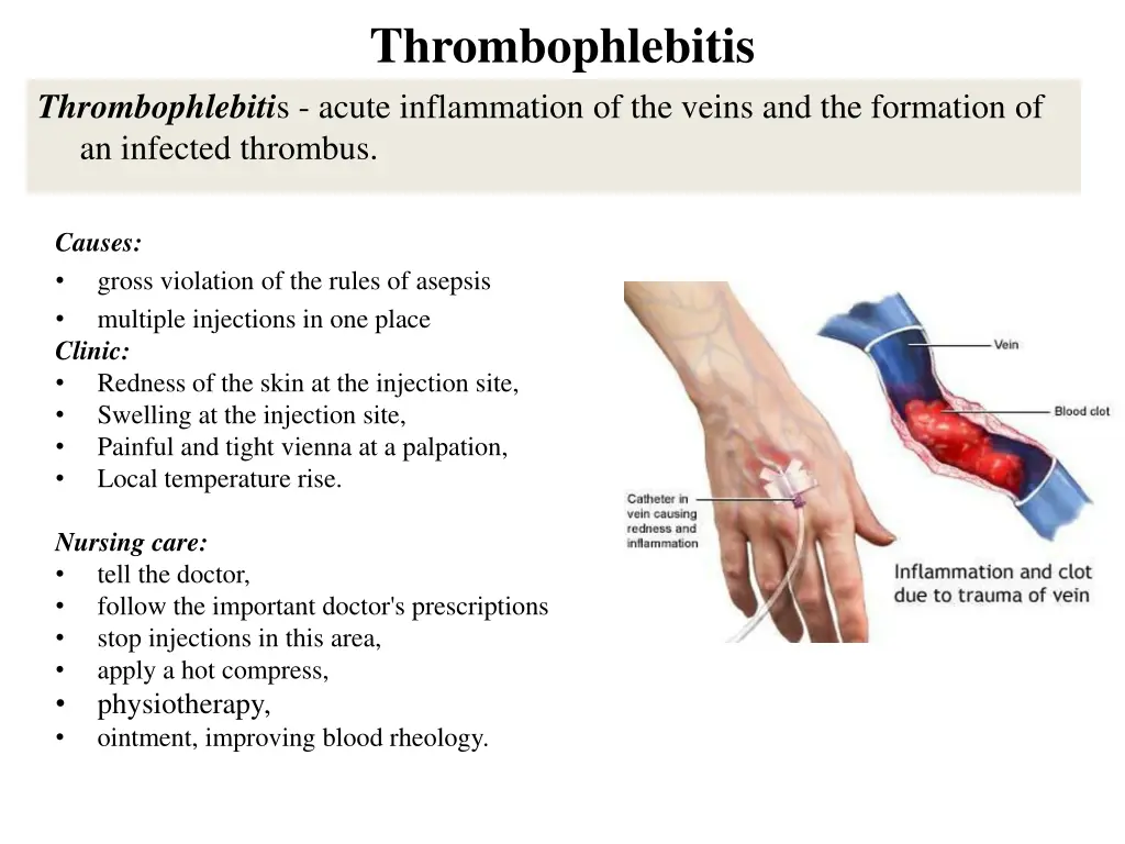 thrombophlebitis