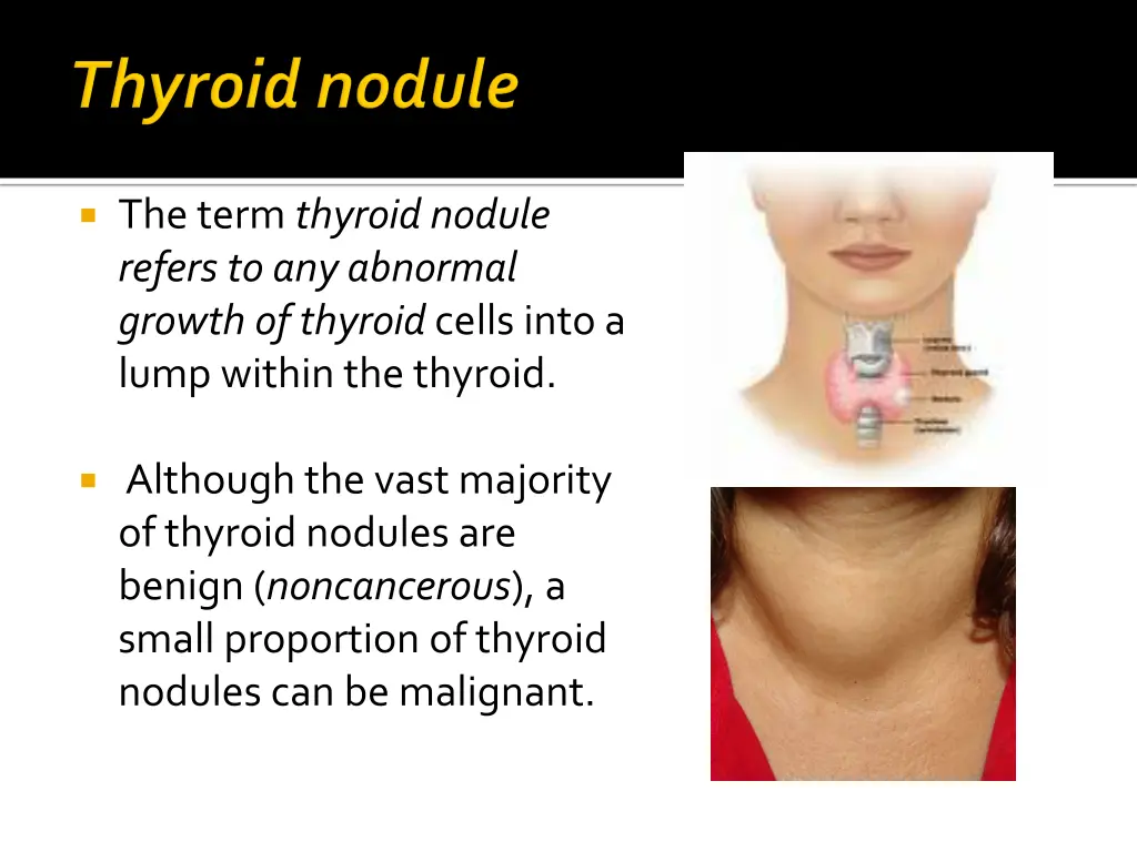 the term thyroid nodule refers to any abnormal
