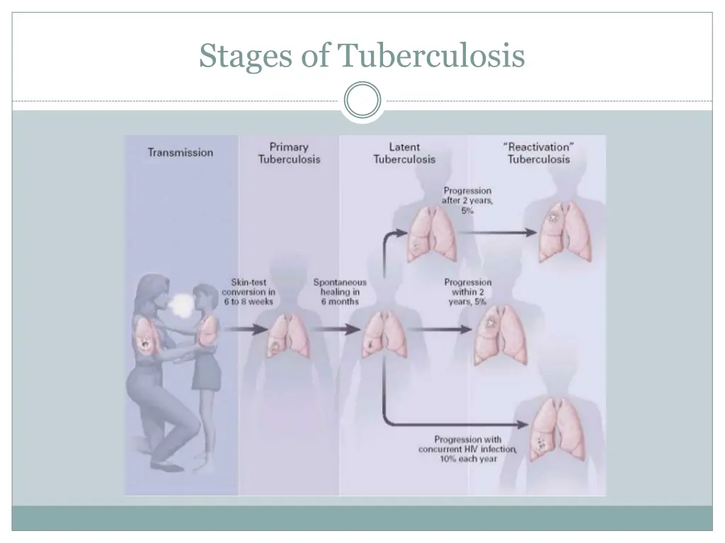 stages of tuberculosis