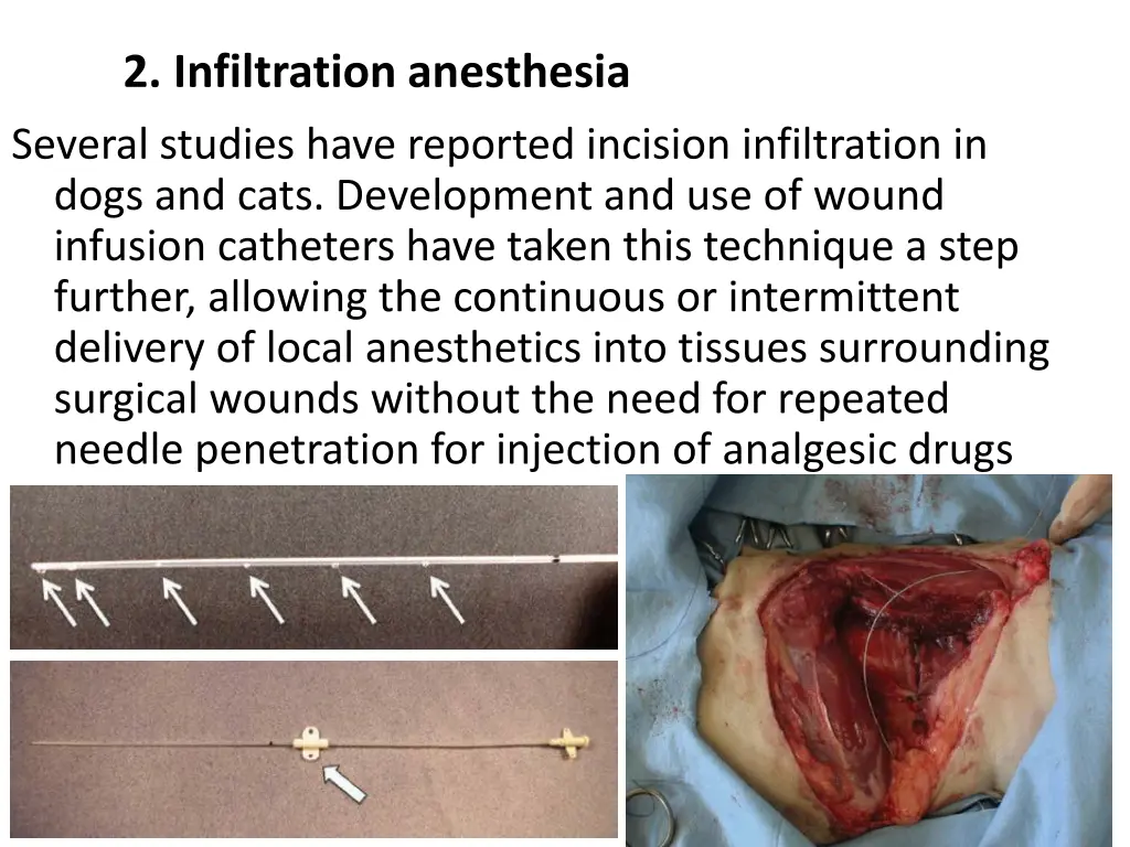 2 infiltration anesthesia 1