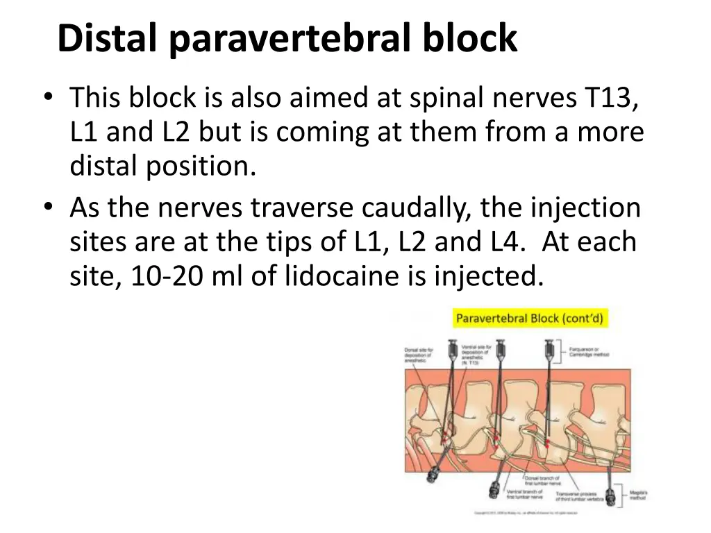 distal paravertebral block