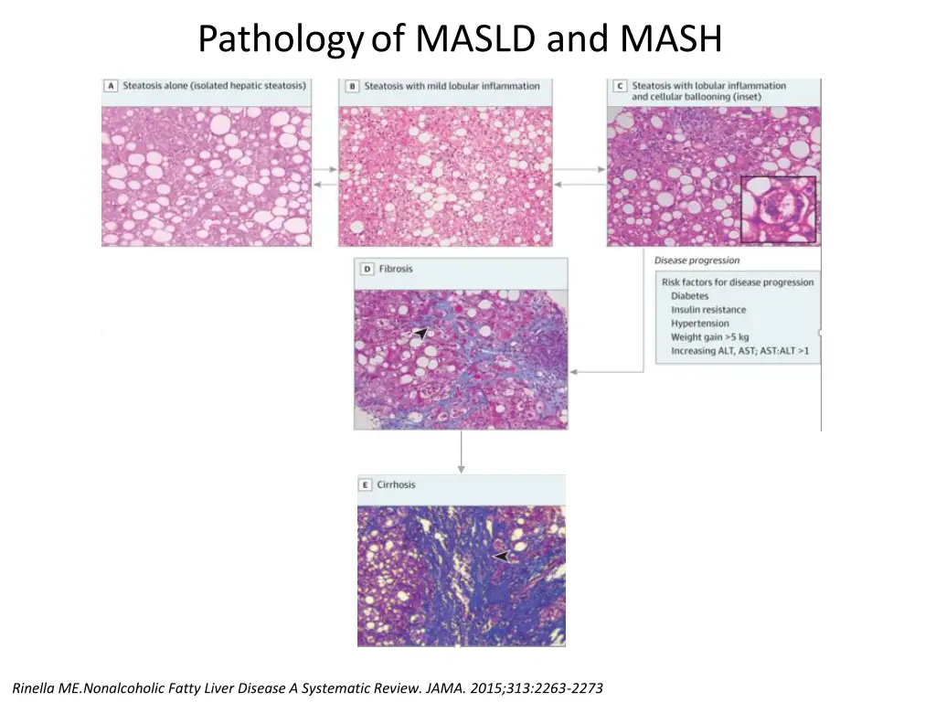 pathology of masld and mash