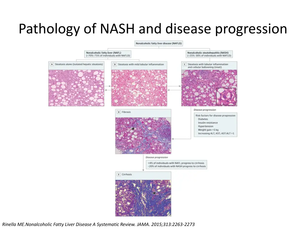 pathology of nash and disease progression