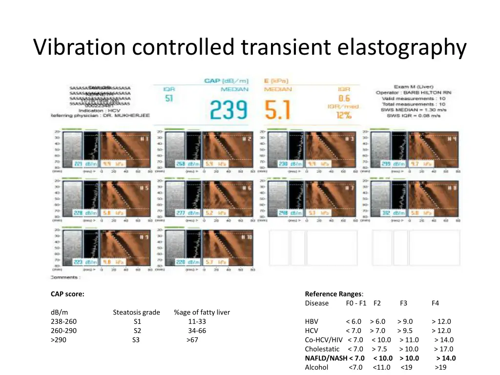 vibration controlled transient elastography