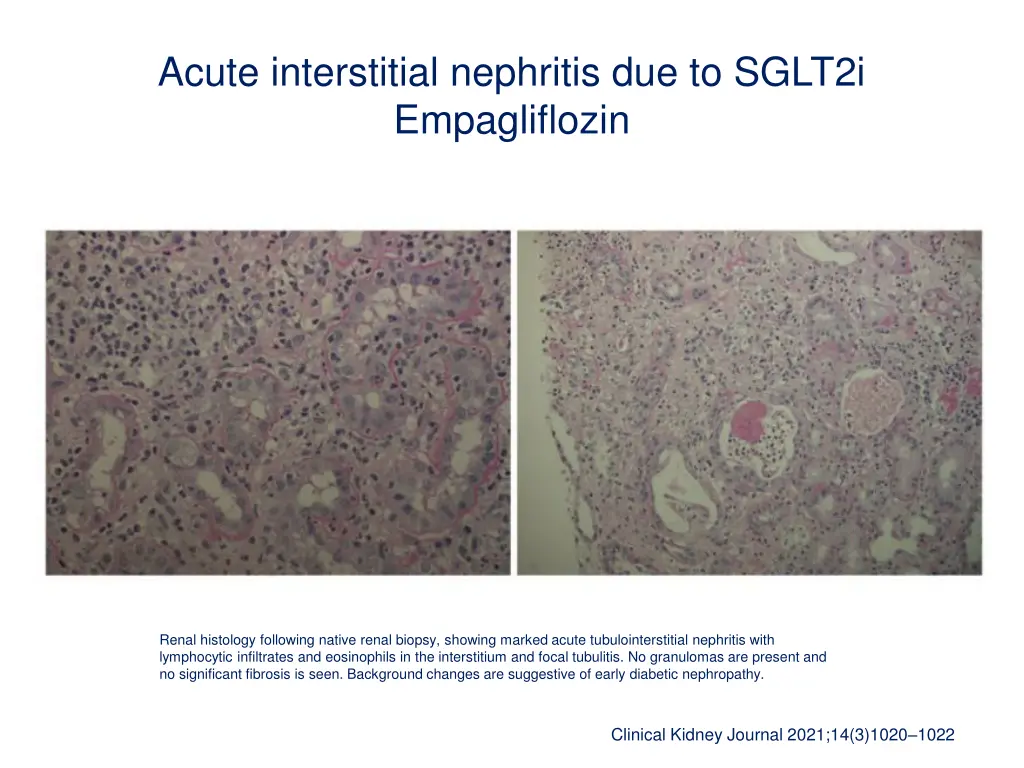 acute interstitial nephritis due to sglt2i