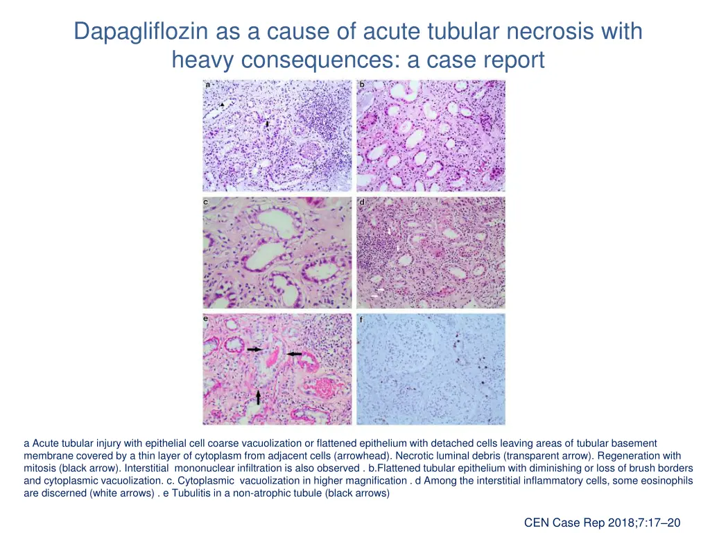 dapagliflozin as a cause of acute tubular