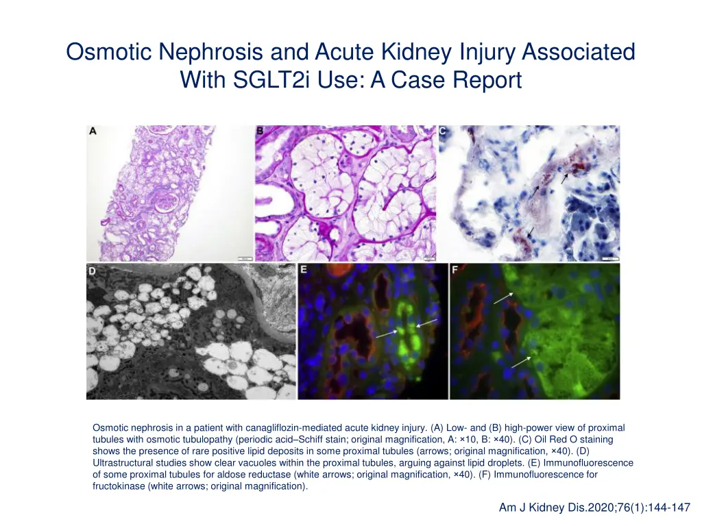 osmotic nephrosis and acute kidney injury