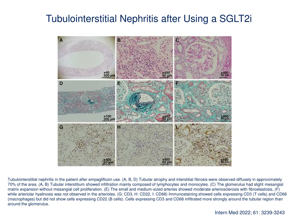 tubulointerstitial nephritis after using a sglt2i