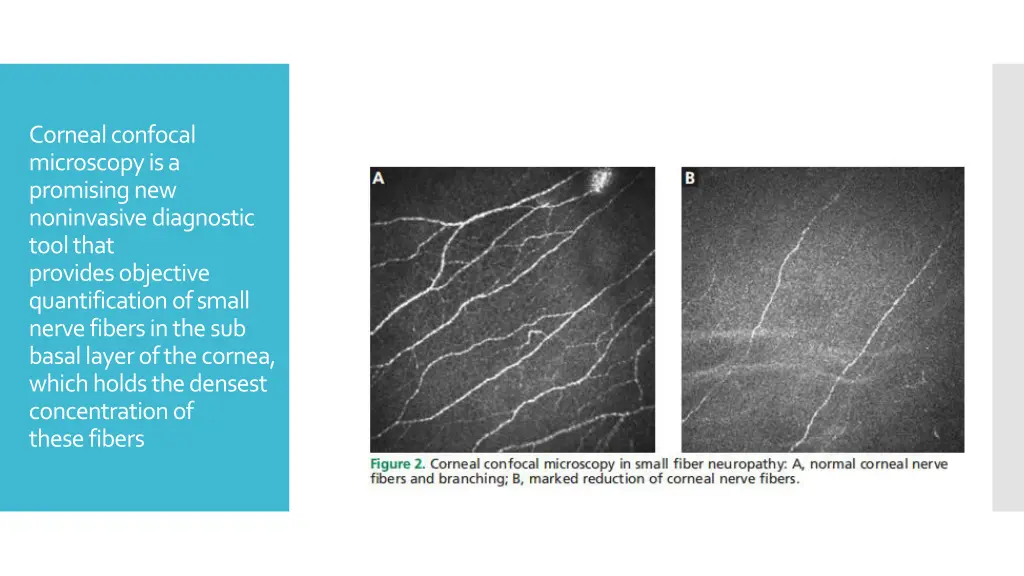 corneal confocal microscopy is a promising